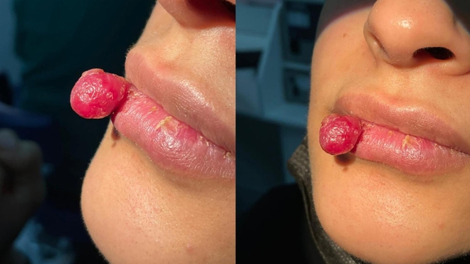 L'une des femmes âgée de 23 ans a développé un impressionannt hémangiome à la lèvre après s'être mordue