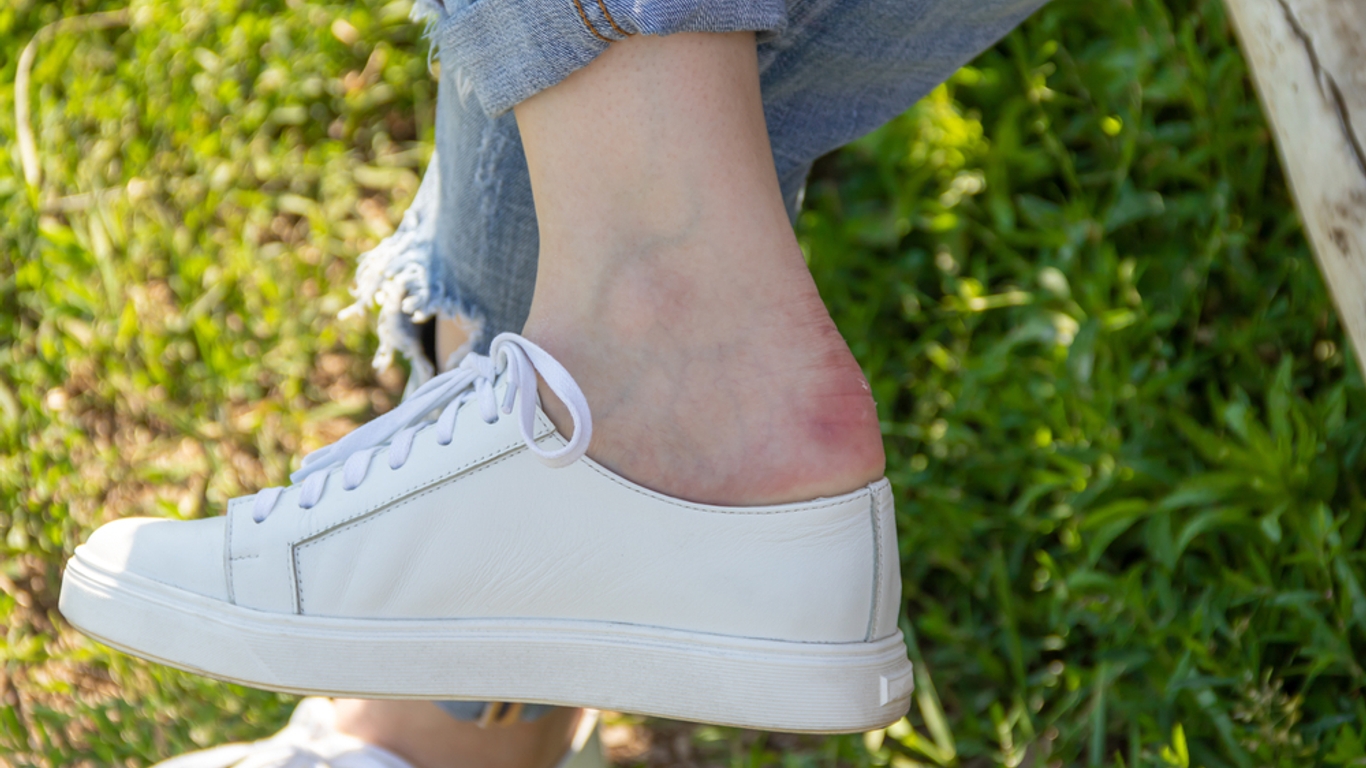 Comment traiter une ampoule au pied et que faire pour l