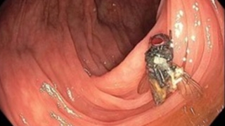 Lors d’une coloscopie, les médecins découvrent une mouche dans son côlon