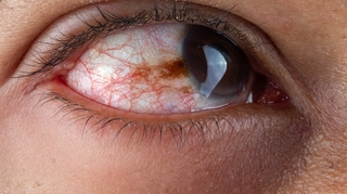 Hausse des cas de syphilis oculaire : ce qu'il faut savoir