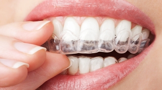 Abcès, brûlure des gencives... quels sont les risques du blanchiment dentaire ?
