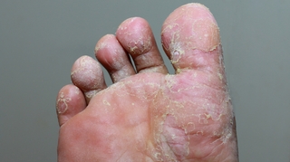 Mycose : comment soigner un "pied d'athlète" ?