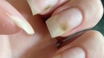 Qu'est-ce que le syndrome des ongles verts, provoqué par la pose d'acrylique ?