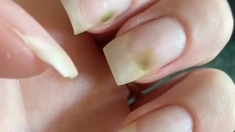 Qu'est-ce que le syndrome des ongles verts, provoqué par la pose d'acrylique ?