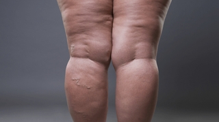 Lipœdème : comment se soigne la "maladie des jambes poteaux" ?