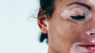 Un premier traitement autorisé contre le vitiligo