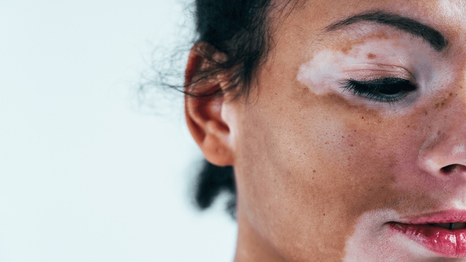 Le vitiligo touche 1 à 2 % de la population mondiale