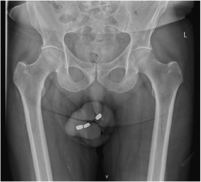 La radiographie pelvienne de l'Australien de 73 ans révèle la présence de trois piles boutons de 1,3 cm de large et 0,3 cm de haut 