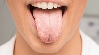 Candidose buccale : quand la mycose infecte la bouche
