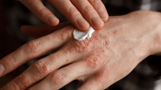 Psoriasis : comment prendre soin de sa peau ?