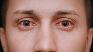 Comment soigner la rosacée oculaire ?