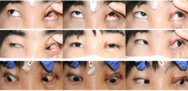 Après la morsure, les yeux de ce Japonais de 19 ans ont subi un désalignement