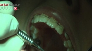 Ch@t : L'orthodontie des adultes