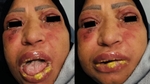 Une femme de 45 ans en soins intensifs après une violente réaction à l’ibuprofène