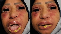 Une femme de 45 ans en soins intensifs après une violente réaction à l’ibuprofène