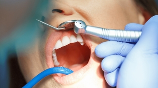 Carie : comment se passe la dévitalisation d’une dent ?