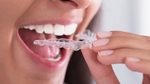 Bruxisme : les solutions pour arrêter de grincer des dents