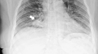 Pneumothorax : quand l'air s'échappe des poumons - AlloDocteurs