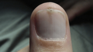 Cette anomalie sur l’ongle pourrait augmenter votre risque de cancer