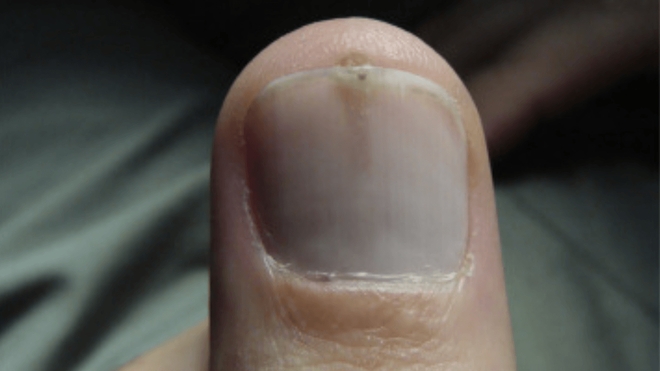 Cette anomalie sur l’ongle pourrait augmenter votre risque de cancer