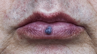 Causes, risques, traitement... Tout savoir sur les angiomes de la lèvre