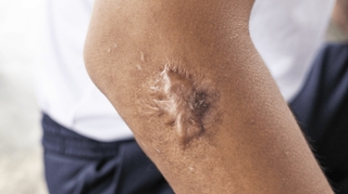 Comment atténuer les douleurs d'une cicatrice chéloïde ?