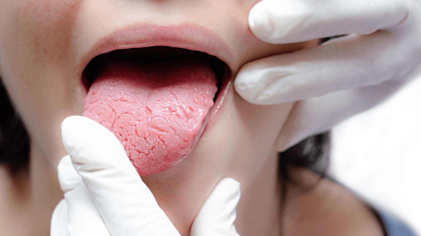 Maladie De La Bouche Symptômes – ILAR