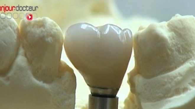 Ch@t : les implants dentaires