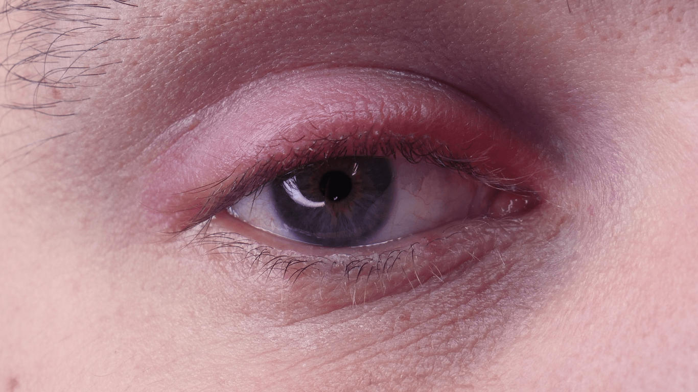 Blépharite : 4 choses à savoir sur les paupières douloureuses ...
