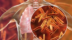 Vers un nouveau vaccin contre la tuberculose ? 