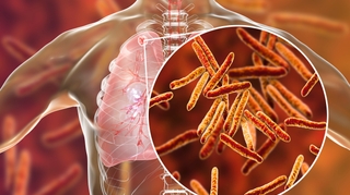 Vers un nouveau vaccin contre la tuberculose ? 