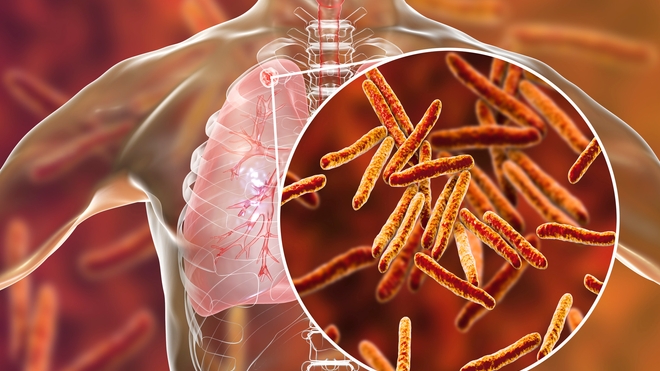 La tuberculose pulmonaire représente 70% des cas de tuberculose dans le monde