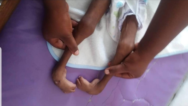 Prise en charge d'un enfant aux pieds bots . Credit photo Benoît NKAMA par Marinette Nguimfack S.