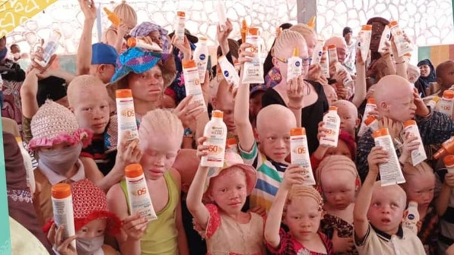 La peau des albinos est très vulnérable face à l'implacable soleil (photo d'illustration)