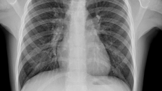 Journée mondiale de la tuberculose : un vrai danger pour les porteurs du VIH
