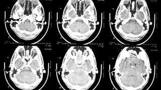 Neurochirurgie : opération du cerveau d'un nouveau genre en RDC
