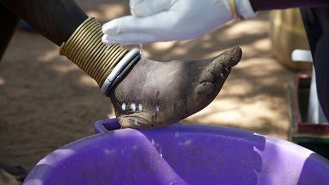 Processus d'extraction d'un ver de Guinée