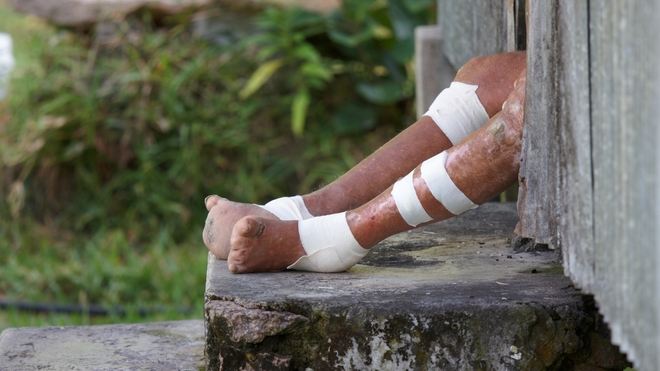 Non traitée, la lèpre déforme, mutile et invalide les personnes atteintes
