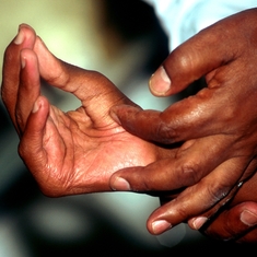 Pourquoi la lèpre sévit toujours en Afrique ?