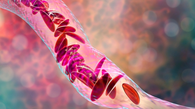 La drépanocytose est très répandue en RDC (photo d'illustration)