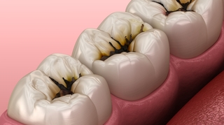Caries : quand les médicaments sont à l'origine du problème