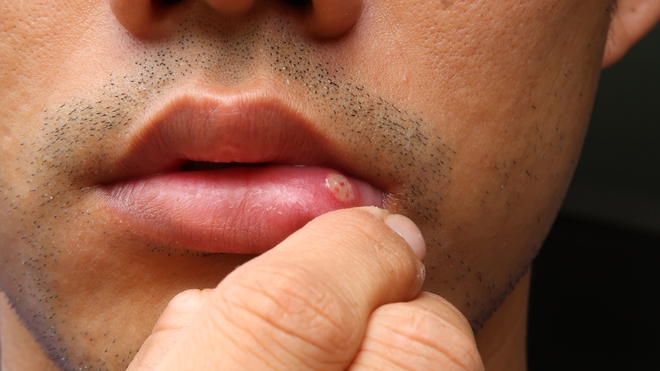 Certains aphtes peuvent être causés par des maladies (photo d'illustration)