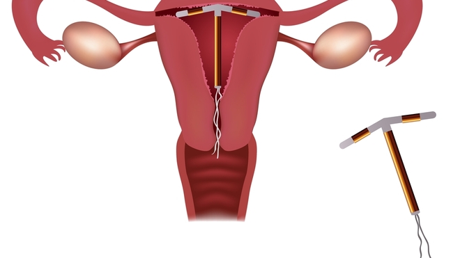 Le DIU est une méthode contraceptive sûre jusqu’à 99% (photo d'illustration)