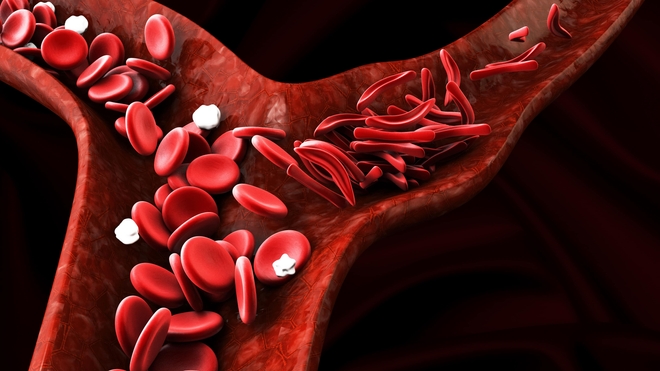 Au cours de la drépanocytose, les globules rouges prennent une forme anormale de faucille (photo d'illustration)