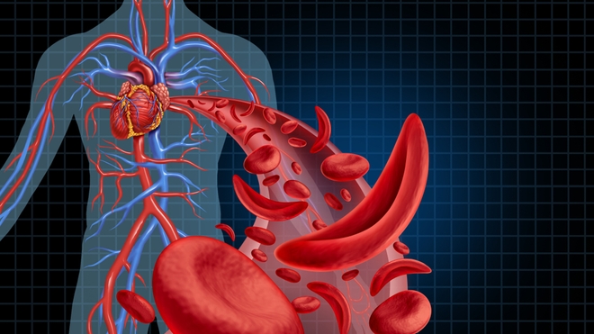 La drépanocytose peut "boucher" les vaisseaux sanguins, en particulier dans les articulations.