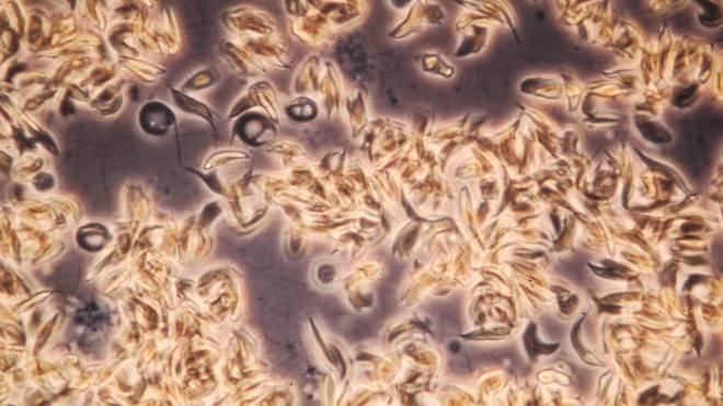Une drépanocystose ou anémie falciforme dûe à une mutation de l'hémoglobine