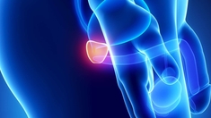 Algérie : progression inquiétante du cancer de la prostate