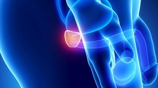 Algérie : progression inquiétante du cancer de la prostate