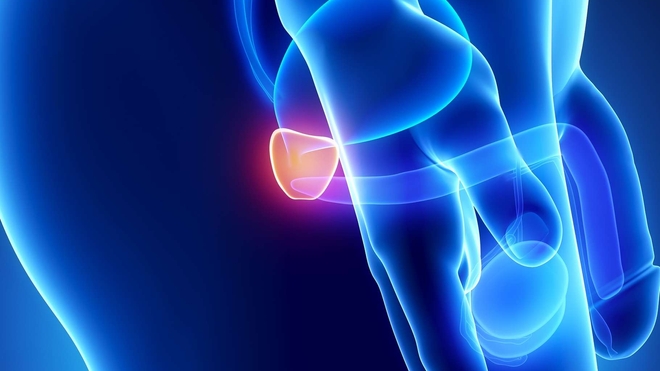 Le cancer de la prostate menace les hommes de plus de 45 ans (Illustration)