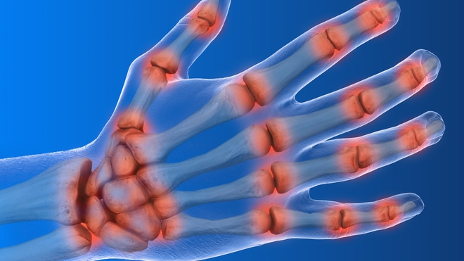L'arthrose est une maladie propre aux os